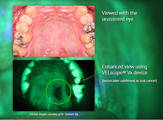 A picture showing how the Velscope identifies oral cancer more efficiently then the naked eye does at A Smiling Heart Dentistry in Bellevue, WA A picture showing how the Velscope identifies oral cancer more efficiently then the naked eye does at A Smiling Heart Dentistry in Bellevue, WA