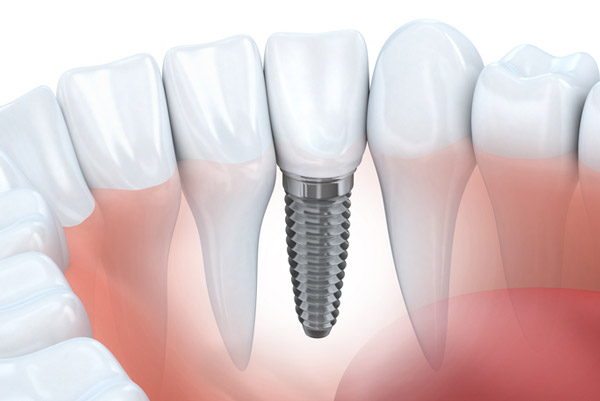 Diagram of a dental implant in a lower jaw from A Smiling Heart Dentistry in Bellevue, WA Diagram of a dental implant in a lower jaw from A Smiling Heart Dentistry in Bellevue, WA